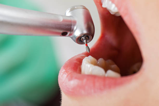 Best Emergency Treatment for Dental Infections or Abscesses in Hillsborough, NJ